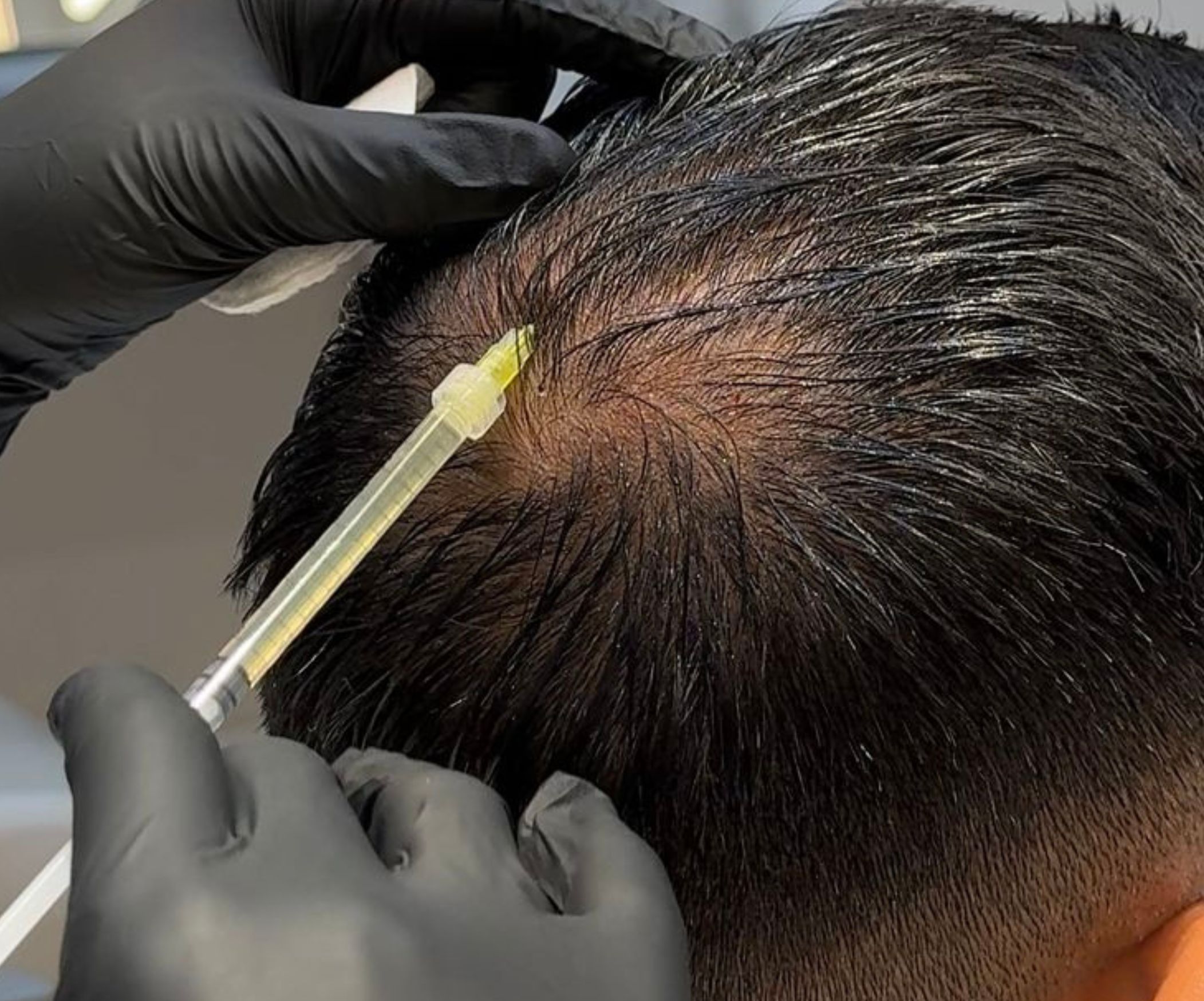 PRP Hair Treatment Cost in Delhi — Ryan Clinic
